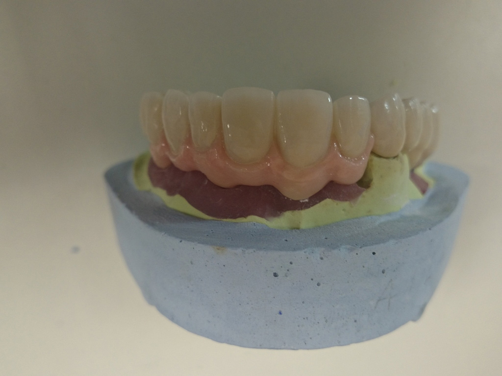 Estructura superior sobre implantes con encía rosa de cerámica