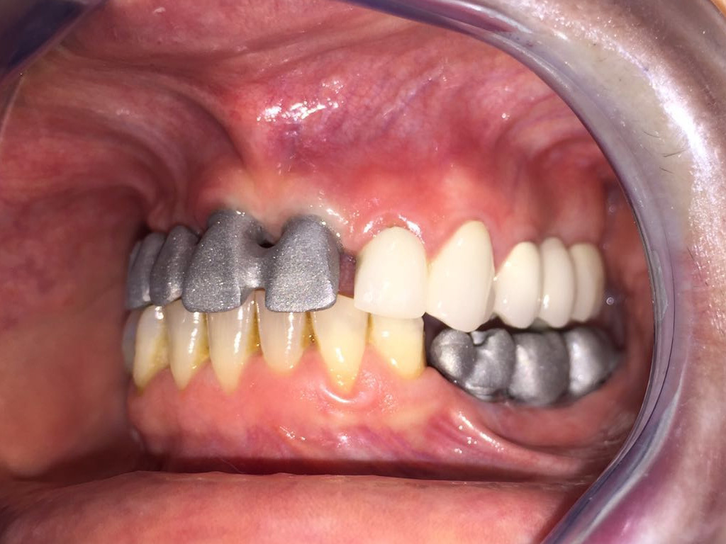 Prueba de estructuras sobre implantes en boca