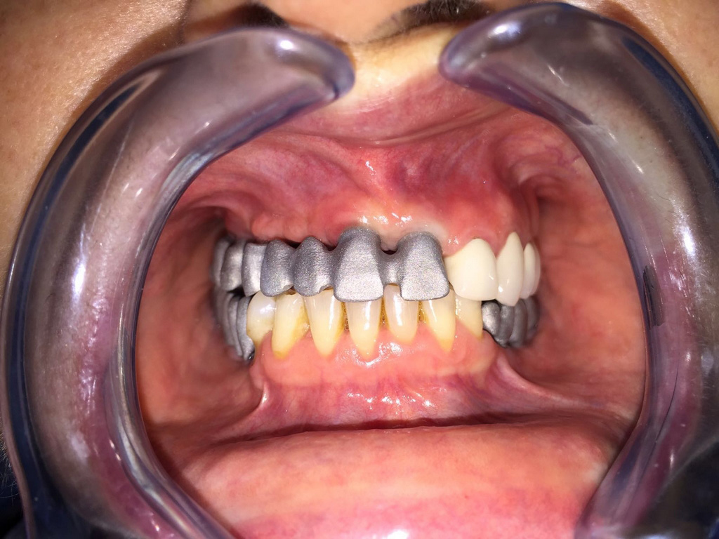 Pruebas de estructuras en boca sobre implantes