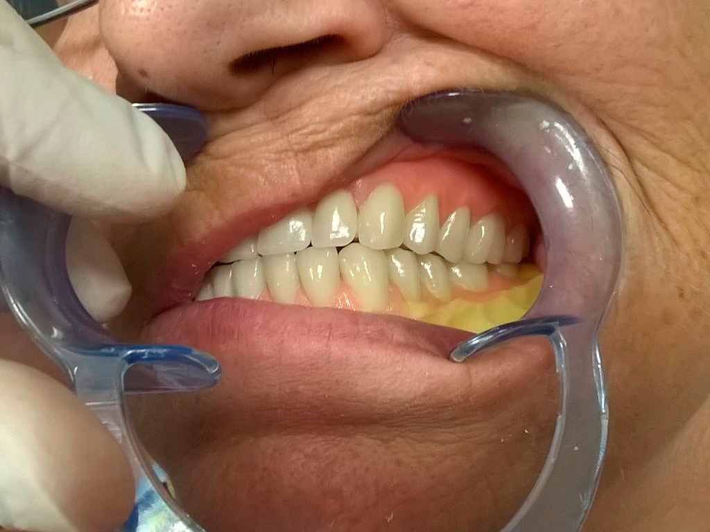 Prueba de dientes de completa superior e inferior