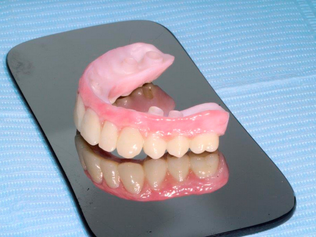 Sobre dentadura de Zirconio con estratificación de cerámica en grupo anterior y encía